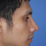Rhinoplasty Before & After Patient #1596