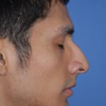 Rhinoplasty Before & After Patient #1596