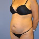 Tummy Tuck Before & After Patient #1100