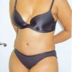 Tummy Tuck Before & After Patient #1099