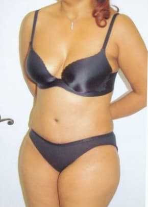 Tummy Tuck Before & After Patient #1099