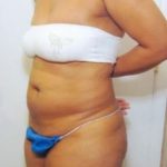 Tummy Tuck Before & After Patient #1099