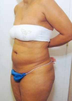Tummy Tuck Before & After Patient #1099