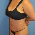 Tummy Tuck Before & After Patient #1098