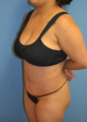 Tummy Tuck Before & After Patient #1098