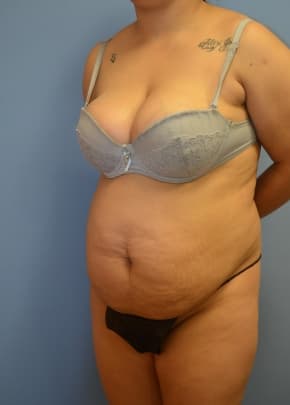 Tummy Tuck Before & After Patient #1098