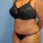 Tummy Tuck Before & After Patient #1096