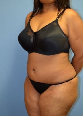Tummy Tuck Before & After Patient #1096