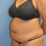 Tummy Tuck Before & After Patient #1096