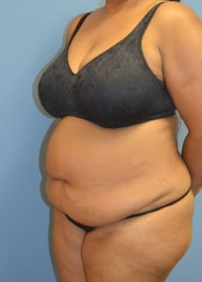 Tummy Tuck Before & After Patient #1096