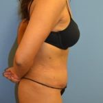 Tummy Tuck Before & After Patient #1095