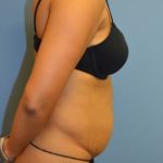 Tummy Tuck Before & After Patient #1095