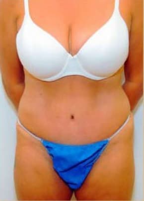Tummy Tuck Before & After Patient #1094