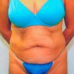 Tummy Tuck Before & After Patient #1094