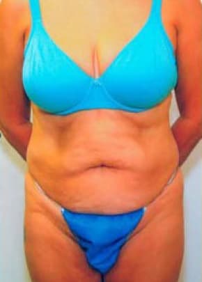 Tummy Tuck Before & After Patient #1094