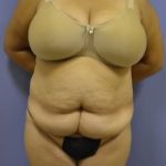 Tummy Tuck Before & After Patient #1093
