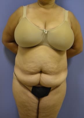 Tummy Tuck Before & After Patient #1093