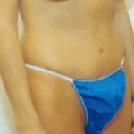 Tummy Tuck Before & After Patient #1092