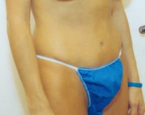 Tummy Tuck Before & After Patient #1092