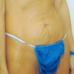 Tummy Tuck Before & After Patient #1092