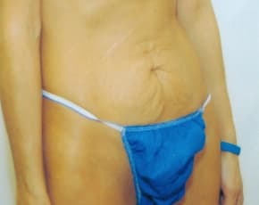 Tummy Tuck Before & After Patient #1092