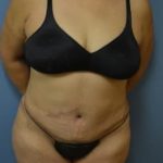 Tummy Tuck Before & After Patient #1091