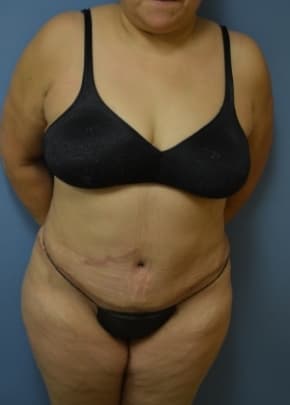Tummy Tuck Before & After Patient #1091