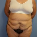 Tummy Tuck Before & After Patient #1091