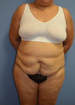 Tummy Tuck Before & After Patient #1091