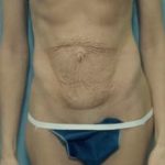 Tummy Tuck Before & After Patient #1090