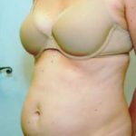 Tummy Tuck Before & After Patient #1089