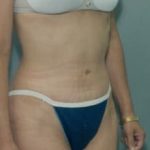 Tummy Tuck Before & After Patient #1088