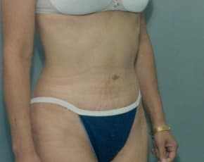 Tummy Tuck Before & After Patient #1088