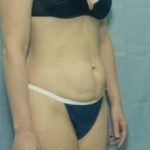 Tummy Tuck Before & After Patient #1088