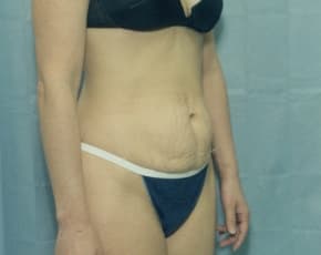 Tummy Tuck Before & After Patient #1088