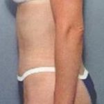 Tummy Tuck Before & After Patient #1087