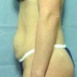 Tummy Tuck Before & After Patient #1087