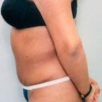 Tummy Tuck Before & After Patient #1086