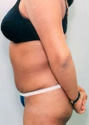 Tummy Tuck Before & After Patient #1086