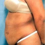 Tummy Tuck Before & After Patient #1086
