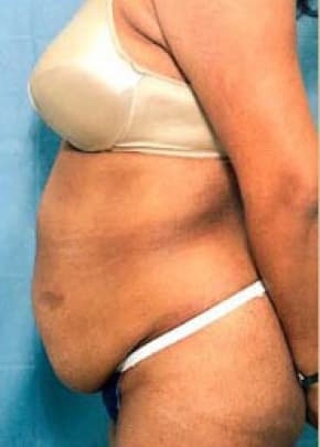 Tummy Tuck Before & After Patient #1086