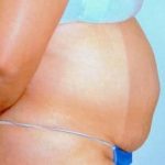 Tummy Tuck Before & After Patient #1085