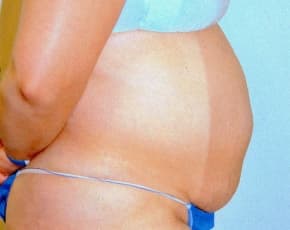 Tummy Tuck Before & After Patient #1085