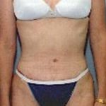 Tummy Tuck Before & After Patient #1084