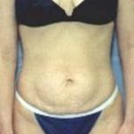 Tummy Tuck Before & After Patient #1084