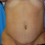 Tummy Tuck Before & After Patient #1083