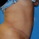 Tummy Tuck Before & After Patient #1083