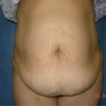 Tummy Tuck Before & After Patient #1083