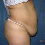 Tummy Tuck Before & After Patient #1083