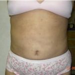 Tummy Tuck Before & After Patient #1082